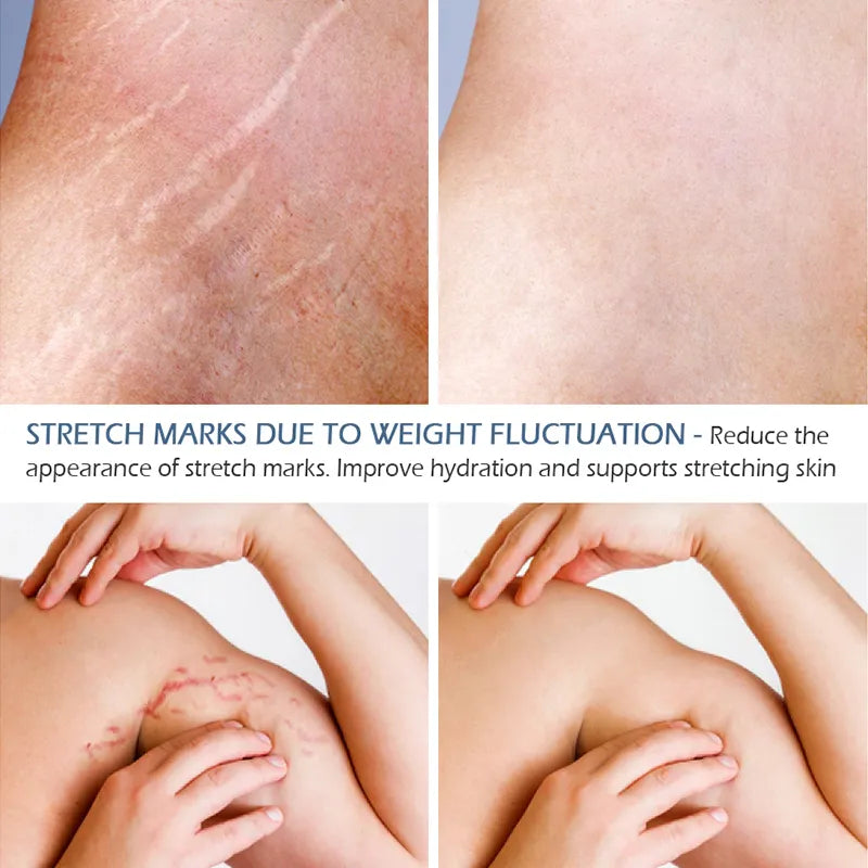 stretch marks remover essential oil