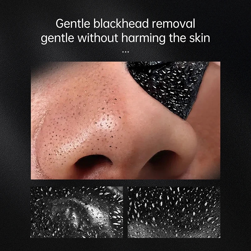 anti acne blackhead remover